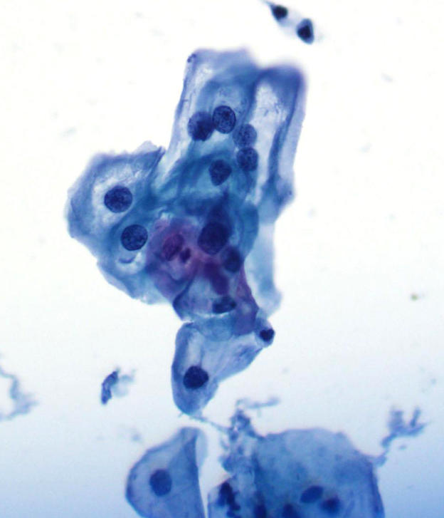<p>What is the diagnosis and recommended follow-up for this pap smear from a 21F</p>