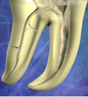 <p>What is “straight line” access?</p>