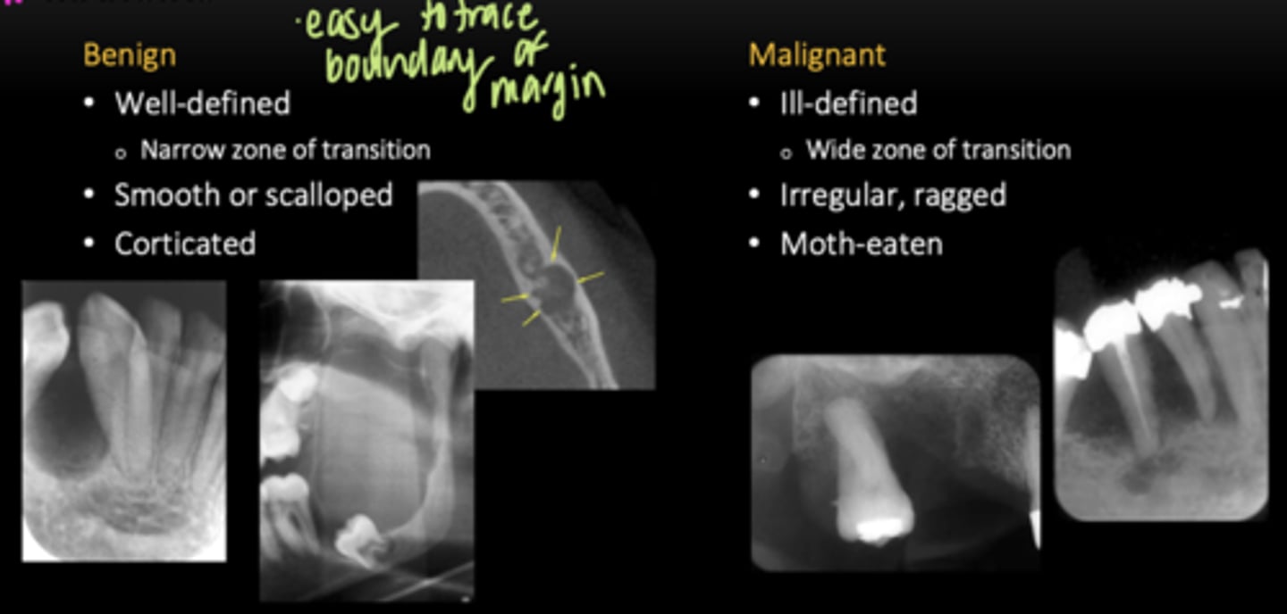 <p>Benign:</p><p>- Well-defined, narrow zone of transition </p><p>- Smooth or scalloped </p><p>- Corticated </p><p>- Easy to trace boundary </p><p>Malignant: </p><p>- Ill-defined, wide zone of transition </p><p>- Irregular, ragged </p><p>- Moth-eaten </p>