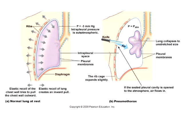 <ul><li><p>disruption of pleural space can lead to collapsed lung</p></li><li><p>if air enters the fluid layer, it loses its pressure and the lung collapses inwards</p></li><li><p>can occur in lung diseases here inflammation causes blisters in the pleural sac, if one blister ruptures it disrupts the membrane</p></li></ul><p></p>
