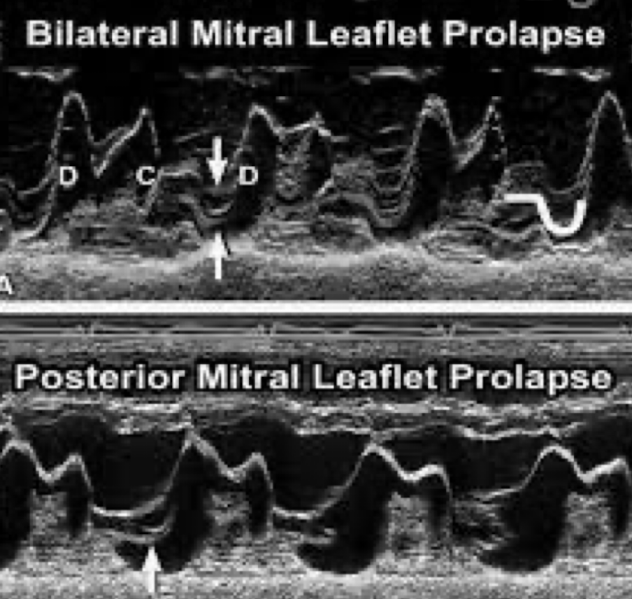 <ul><li><p><strong>mid to late systolic “sagging”</strong> back of the anterior, posterior or both MV leaflets <em>> 2 mm from the C-D points</em></p></li></ul><p></p><ul><li><p><strong>holosystolic (pansystolic) “sagging”</strong> back of the anterior, posterior or both MV leaflets from<em> ≥ 3 mm from the C-D points</em> of the MV</p></li></ul><p></p>