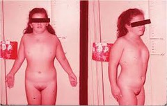 <p>- Short stature, broad chest</p><p>- Widely spaced nipples </p><p>- Webbed neck</p><p>- Swollen hands and feet</p><p>- Horse-shoe kidney (fused, sits lower in pelvis)</p>