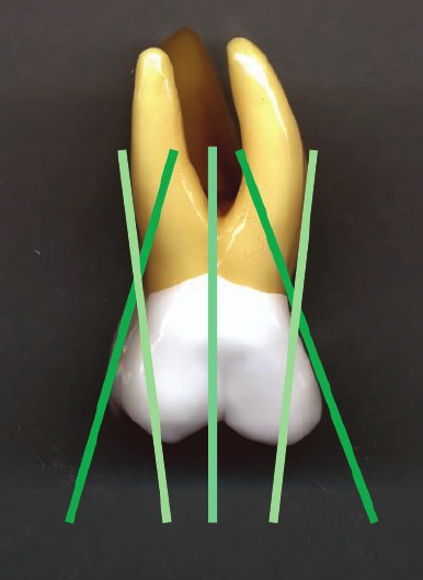 <ul><li><p>Look at surface you’re working on — orient lower shank so it’s in the same direction as the tooth being instrumented on</p></li></ul><p><span style="color: rgb(255, 0, 0);"><strong>Lower shank must be parallel to tooth surface </strong></span></p><p></p><ul><li><p>Tooth has many orientations</p></li><li><p>Root surfaces point in different direction</p></li></ul><p></p><p>As you move around tooth…</p><ul><li><p>Orientation must change too </p></li></ul><p></p>