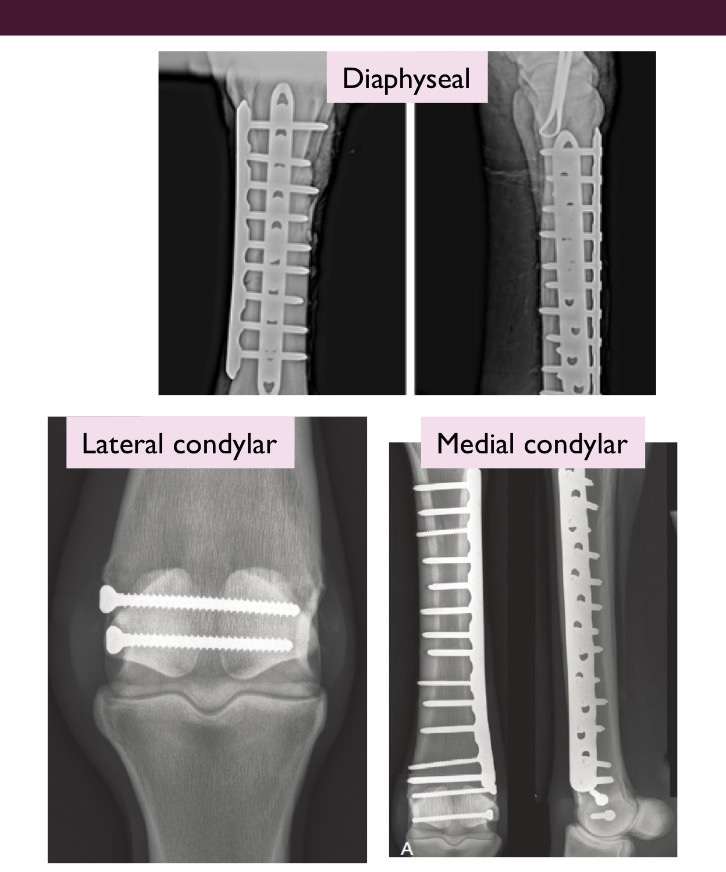 <p>what internal fixation used for lateral condylar and proximal palmar MC3 fracture</p>