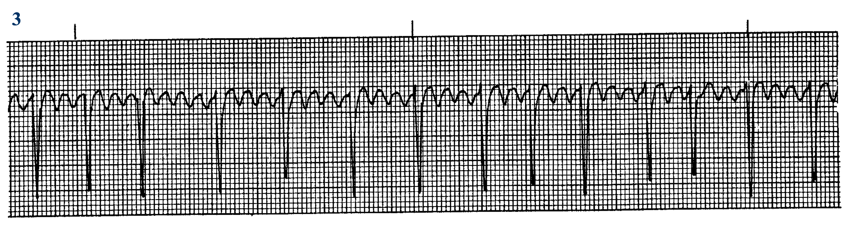 <p>What ECG is this? </p>