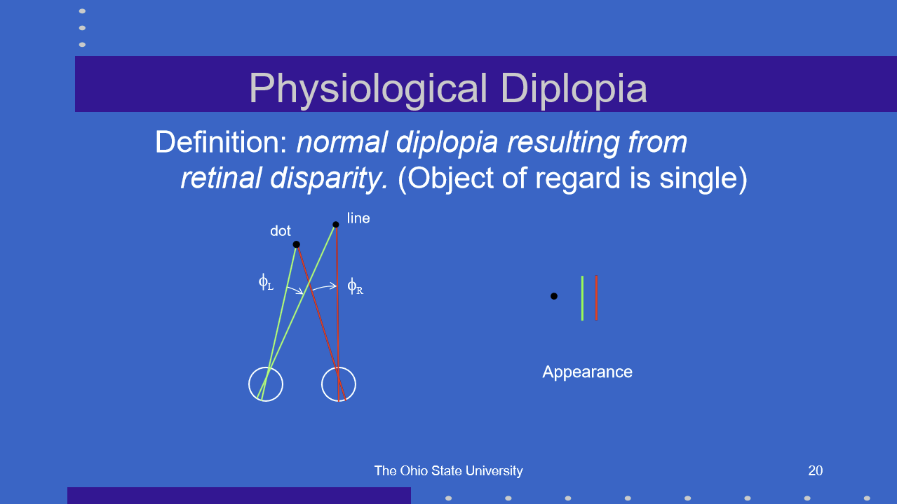 <p>Physiological diplopia is normal double vision caused by retinal disparity of objects that are not being fixated.</p><p>The object of regard is single because fixation places that object on corresponding retinal points, usually both foveas.</p><p>Nearby or farther nonfixated objects can appear double because they fall on noncorresponding retinal points.</p>