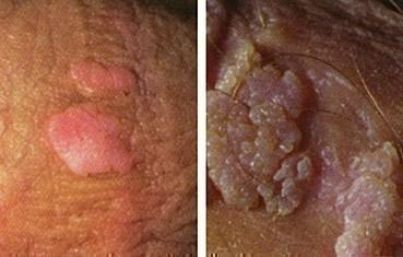 <p>STI due to different strains of the human papilloma virus</p><p>-Presentation: cauliflower-like vaginal lesions that are normally flat, pedunculated flesh-colored growths </p><p>-Dx: clinical, biopsy if immunocompromised/refractory to treatment/postmenopausal </p><p>-Tx: Podofilax/imiquimod (self-applied), TCA or cryoablation, TCA preferred in pregnancy</p>