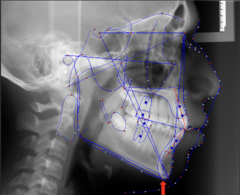 <p>which anatomical landmark:</p><p>- Most inferior point of the symphysis</p>