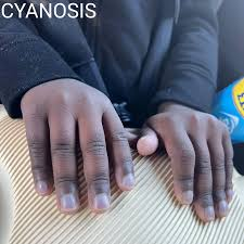 <p>Bluish discoloration to the skin due to decreased circulating O2</p>