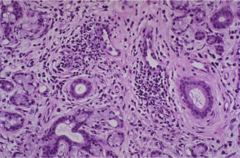 <p>Sjogren syndrome (autoimmune destruction of exocrine glands)</p><p>Can have RF, Anti-SSA or SSB</p><p>Lymphocytic sialadenitis</p><p>Risk of B-cell lymphoma</p>