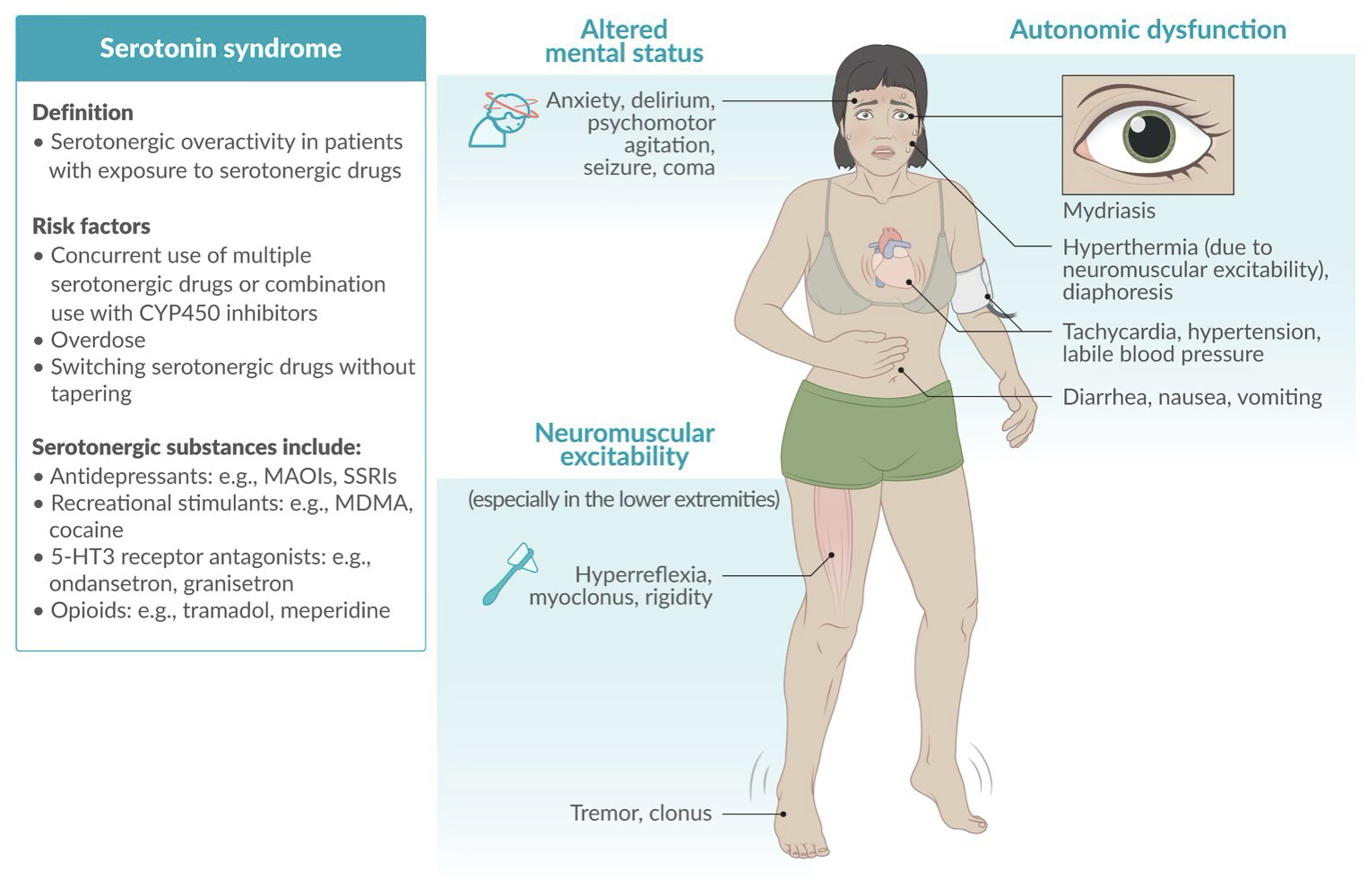 <p>Serotonergic overactivity in patients with exposure to serotonergic drugs.</p><ul><li><p>Altered mental status - anxiety, delirium, agitation, seizure, coma, psychomotor</p></li><li><p>Autonomic dysfunction - mydriasis, hyperthermia, diaphoresis, tachycardia, hypertension, labile blood pressure</p></li><li><p>Neuromuscular excitability - hyperreflexia, myoclonus, rigidity, tremor</p></li></ul><p></p><p>Risk factors:</p><ul><li><p>concurrent use of multiple serotonergic drugs or combination use with CYP450 inhibitors</p></li><li><p>overdose</p></li><li><p>switching serotonergic drugs without tapering</p></li></ul><p></p>
