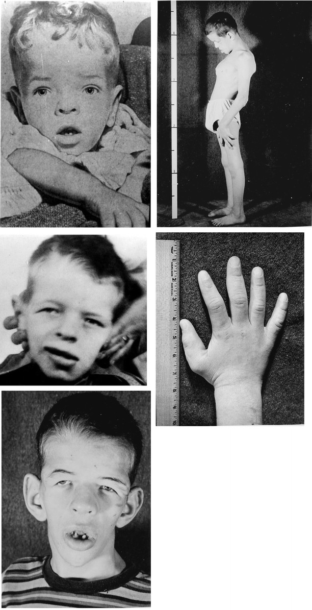 <p>X-linked dominant: Facial dysmorphism; digit abnormalities; psychomotor and growth retardation.</p>