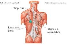 <p>A small triangular gap between the trapezius (medial border), the medial border of the scapula (lateral border), and the latissimus dorsi muscle (inferior border).</p>