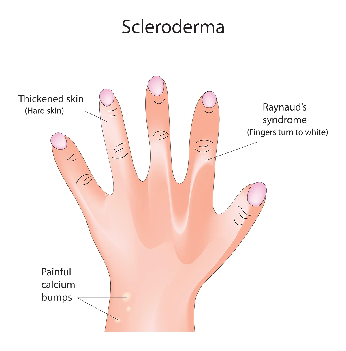<p>What is scleroderma?</p>