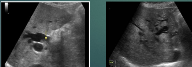 <p>Second most common primary malignant tumor</p>