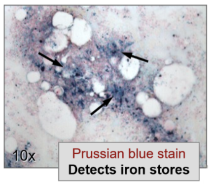<ul><li><p><span style="background-color: transparent;">Evaluates number and type of precursor cells</span></p></li></ul><ul><li><p><span style="background-color: transparent;">Restricted to anemias due to production defects</span></p></li></ul><ul><li><p><span style="background-color: transparent;">Can also assess bone marrow iron stores with Prussian blue iron stain</span></p></li></ul><p></p>