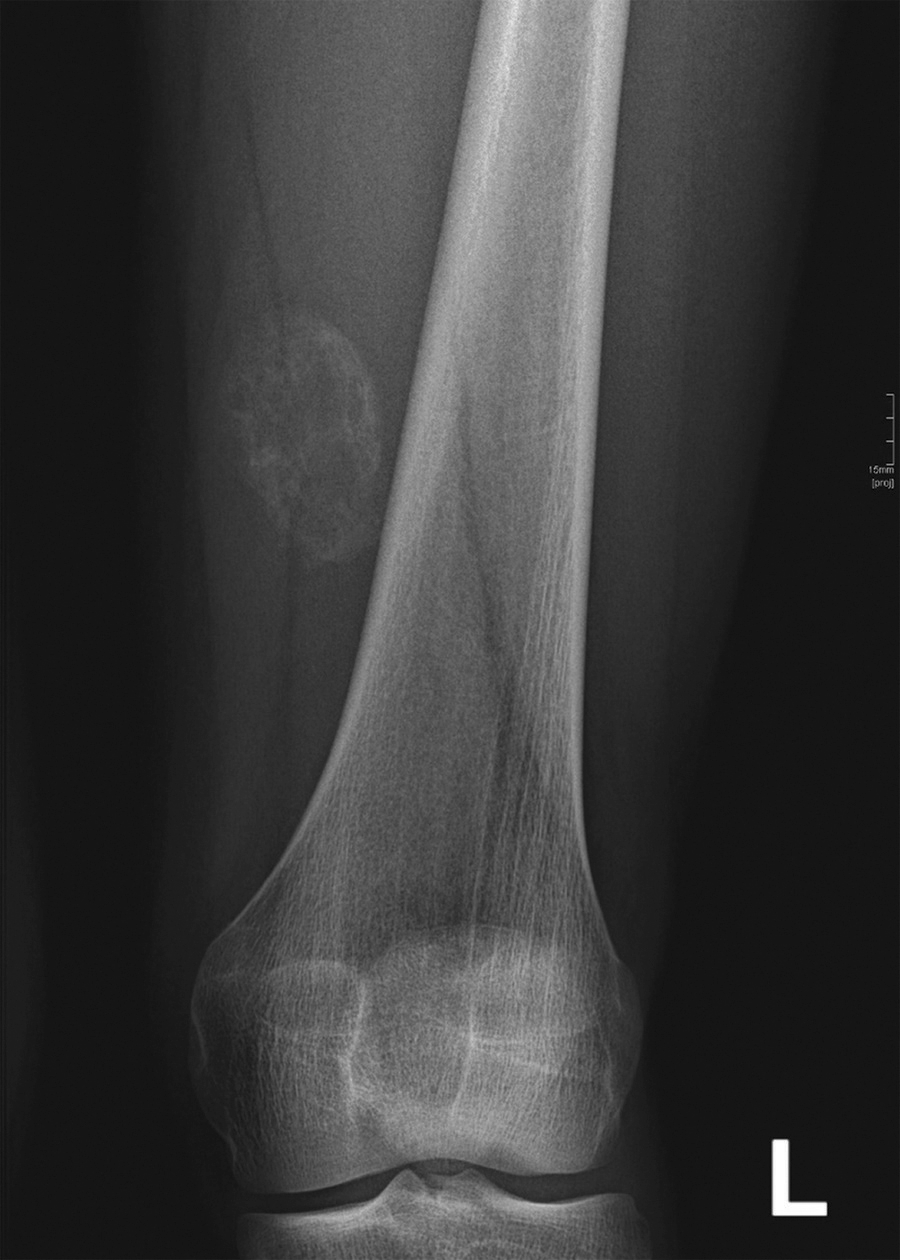 <p>Myositis ossificans</p>