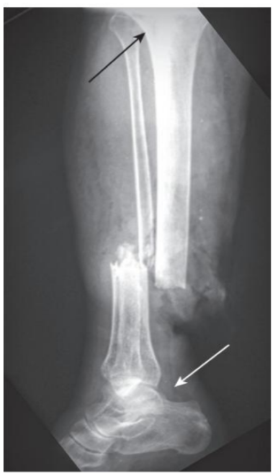 <p>fracture orientation</p>