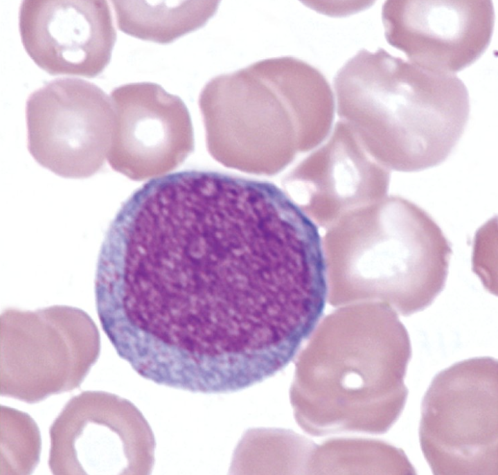 <p>Myeloblast</p><p>14-20 micrometers, N:C 6:1, indented nucleus &amp; thin chromatin strands, moderate blue cytoplasm usually w/o granules, 2-5 nucleoli. CD markers 45, 38, 34, 33, 13, HLA-DR</p>