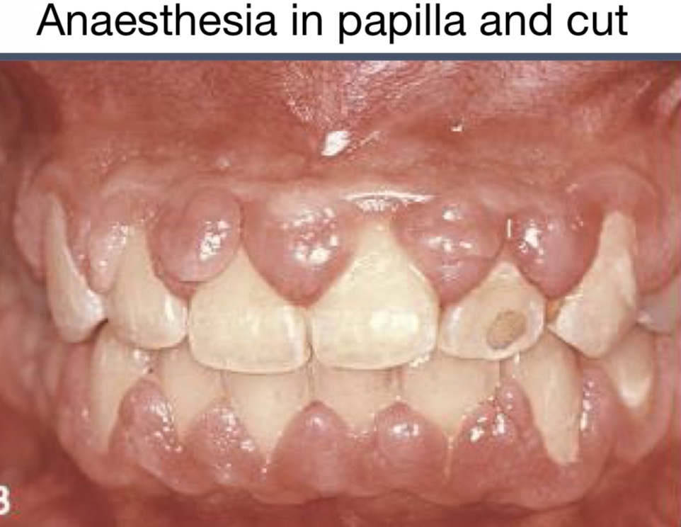 <p>Phenytoin</p><p>Ethotoin</p><p>Mephenytoin</p><p>Valproic acid</p><p>Nifedipine</p><p>Diltiacem</p><p>Cyclosporine</p>