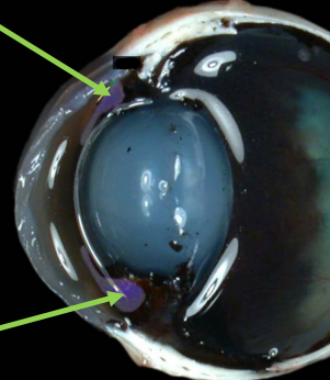 <p>• Colored portion of the eye </p><p>• Pigmented, muscular diaphragm that controls the amount of light that enters the posterior part of the globe</p>