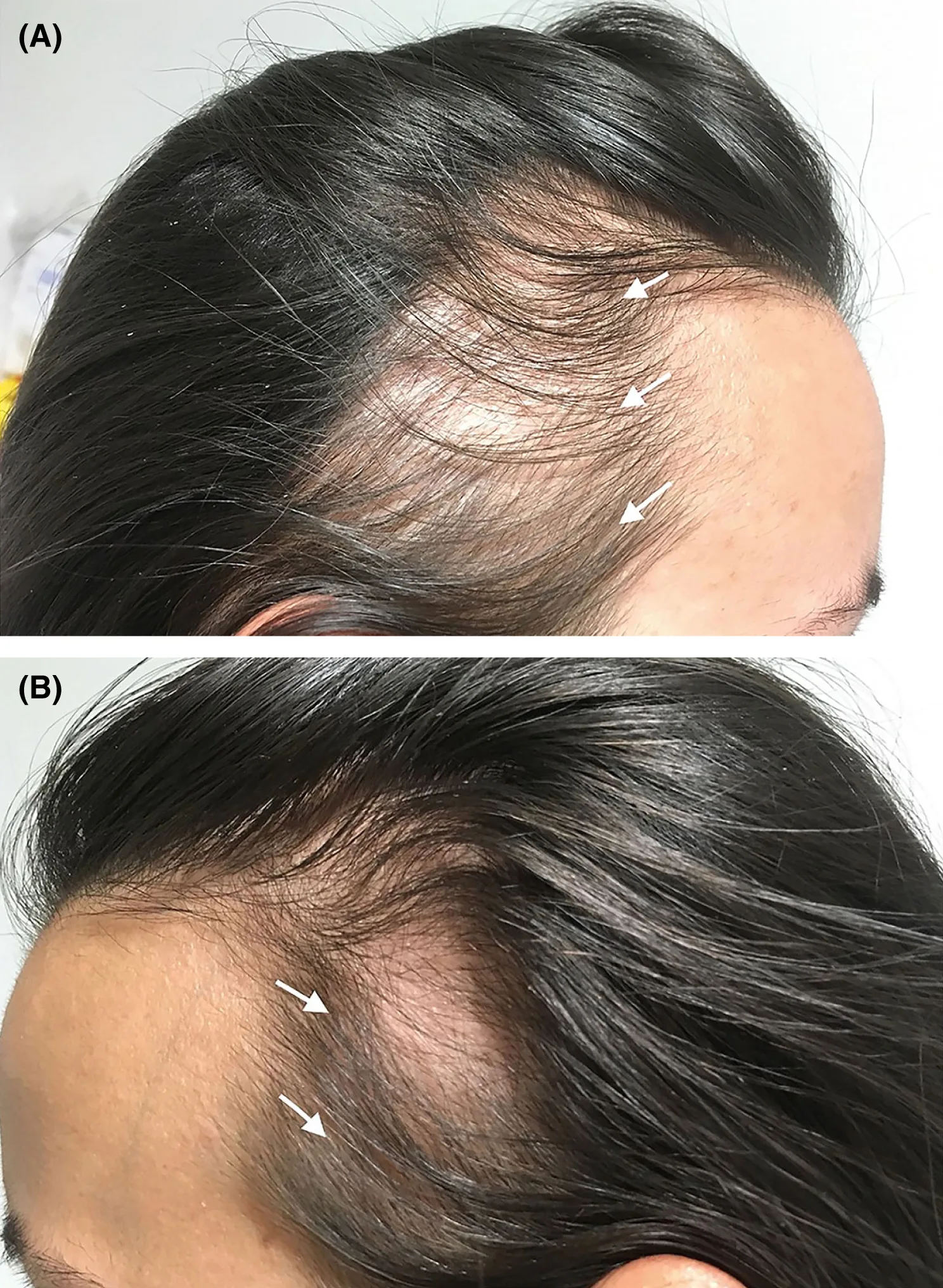 <p>Hair loss resulting from prolonged, tightly pulled hairstyles.</p>