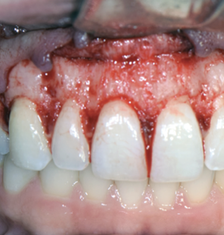 <p><span>1. Full-Thickness Flap</span></p>