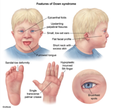 <p>- Flat face/nose, low set ears, almond eyes, poor muscle tone, shorter height, palmar crease</p><p>- Heart/GI Malformations</p><p>- Intellectual disability, Early Alzheimer's </p><p>- ↑ Risk of leukemia</p>