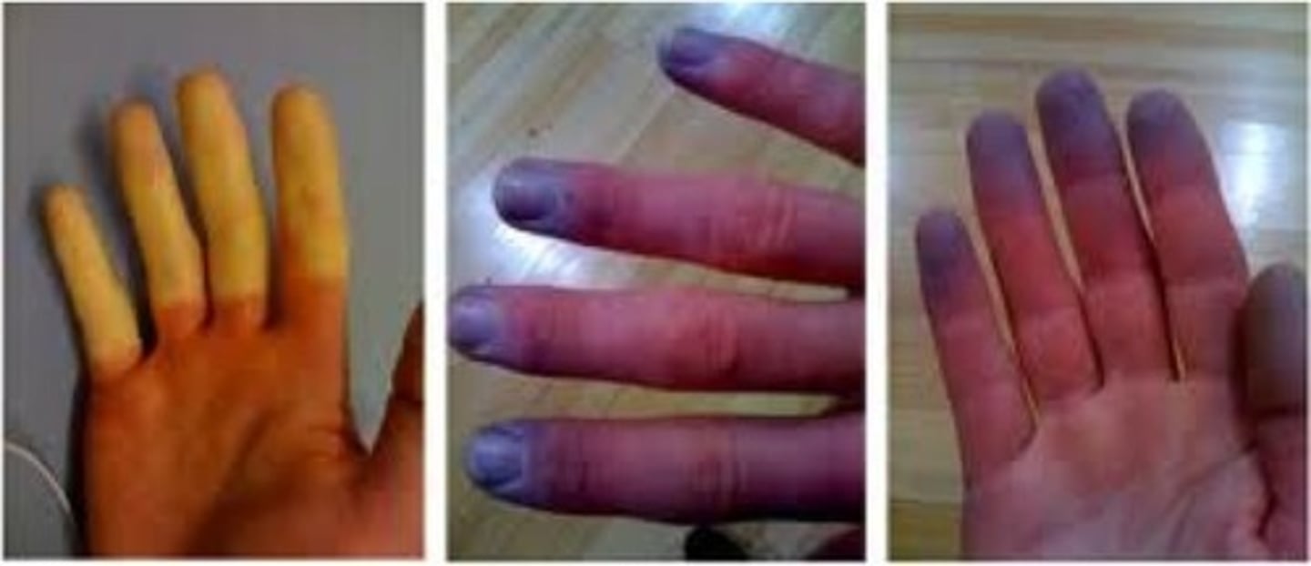 <p>autoimmune, sporadic vasoconstriction then relaxation, happens in hands/toes usually</p>