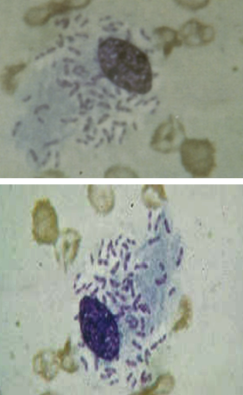 <p>⚠️‼️(#4)21.These pathognomonic lesions with safety pin appearance are caused by: A.Calymmatobacterium granulomatis B.Hemophilus ducreyi C.HSV type 2 D.Neisseria gonorrhea</p>