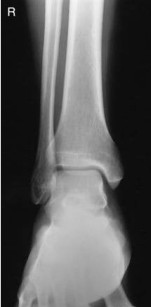 <p><strong>What is the correct evaluation criteria for an AP ankle projection?</strong></p>