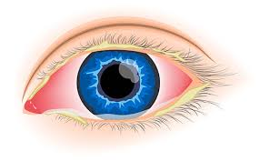 <p>E: s aureus<br>s pneumonia<br>h influenzae<br>gonorrhea<br>chlamydia</p><p>CM: unilateral/bilateral<br>mucopurulent discharge<br>open eyes→“glued shut”<br>discomfort</p><p>TX: topical abx eye drops (gtts)</p>