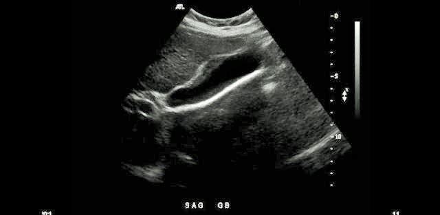 <p>Use your mouth to place your cursor over the main lobar fissure </p>