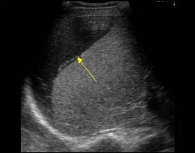 <p>is the blood in this hematoma fresh or older</p>