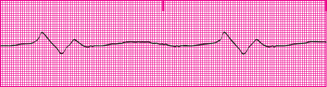 <p>Which rhythm is this?</p>