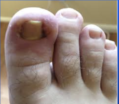 <p>Condition in which the nail pierces the lateral nail fold and grows into the dermis.</p>