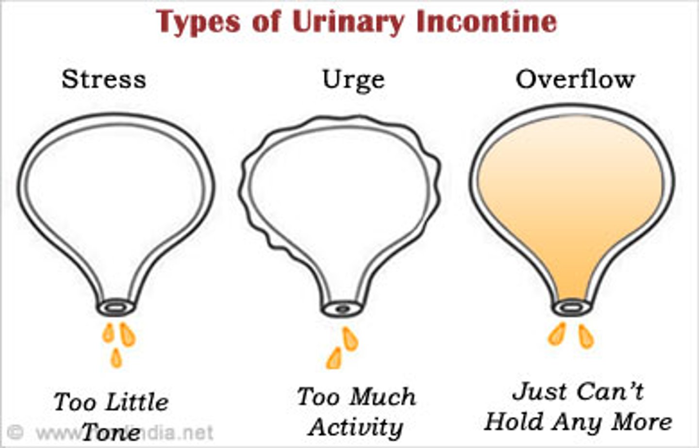 <p>C) Incompetent bladder sphincter leading to overflow of urine, often seen in older adults and those with spinal cord or brain injuries</p>