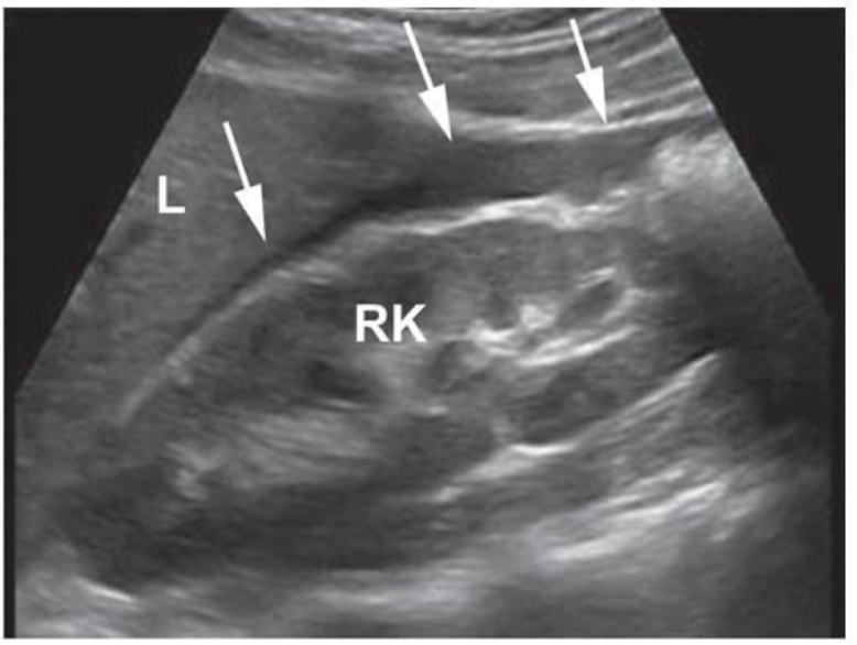<p>Where is this image showing fluid?</p>