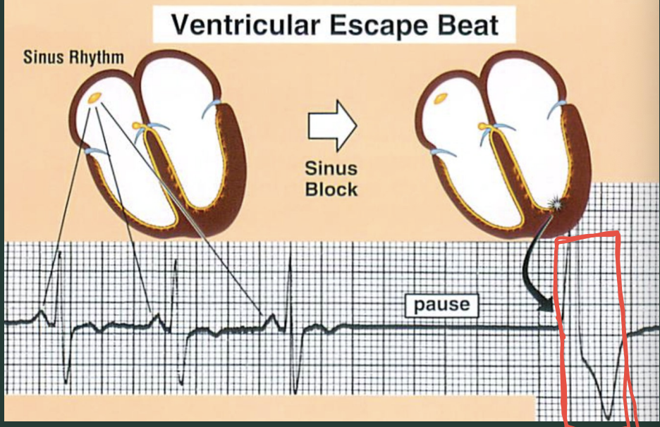 <p>What’s a ventricular escape beat?</p>