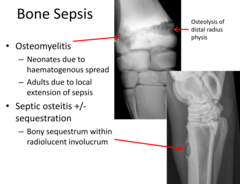 <p>osteomyelitis or septic osteitis +/- sequestration</p>