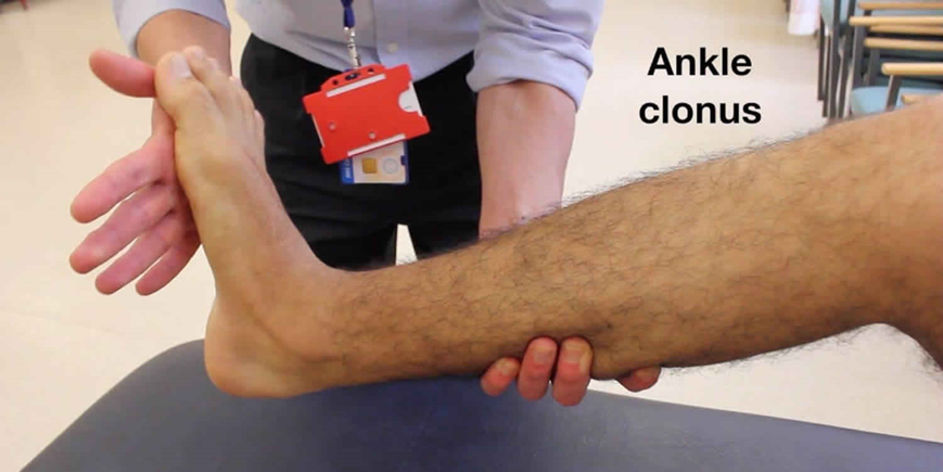 <ul><li><p>Decreased reflexes and loss of sensation below the level of injury</p></li><li><p>Motor loss- flaccid paralysis below the level of injury</p></li><li><p>Sensory loss- loss of touch, pressure, temperature, pain, and proprioception perception below the injury</p></li><li><p>Last days to weeks Maks post-injury function</p></li><li><p>Sign of the return of function</p></li><li><p>Clonus</p></li></ul><p></p>