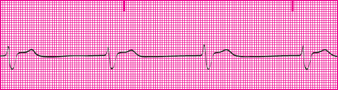 <p>Which rhythm is this?</p>