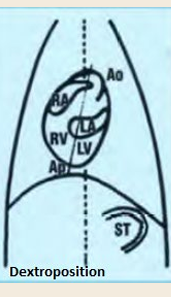 <p>Dextroposition</p>