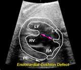<p><strong><mark data-color="yellow" style="background-color: yellow; color: inherit;">endocardial cushion defect</mark></strong></p><p>aka: <strong>atrioventricular septal defect (AVSD)</strong> or <strong>AV canal defect</strong>.</p>