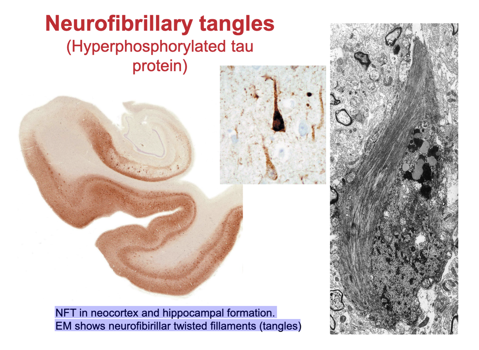 <p>Hyperphosphorylated tau protein</p><ul><li><p>NFT in neocortex and hippocampal formation. </p></li></ul><ul><li><p>EM shows neurofibrillary twisted filaments (tangles)</p></li></ul><p></p>