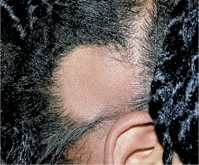 <p>What does this refer to</p><ul><li><p>Common form of non-scarring alopecia</p></li><li><p>Autoimmune disorder</p></li><li><p>Usually occurs in patches</p></li><li><p>May also progress to loss of all scalp or body hair</p></li><li><p>May also occur at the occiput scalp margin (ophiasis)</p></li></ul><p></p>