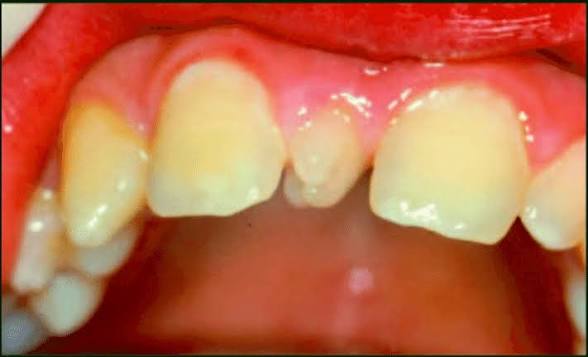 <p>Presencia de dientes supernumerarios en la boca. </p>