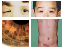 <p>What is the most likely diagnosis ?</p>