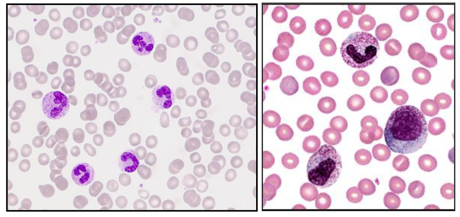 <p>- Increase in neutrophils with left shift and increased granulation</p><p>- secondary to infection, inflammation, tissue damage, drugs, cytokines</p><p>.</p><p>- A neutrophil left shift signifies an increased number of immature neutrophils (such as band cells) in the bloodstream, indicating the bone marrow is releasing them early to fight acute infection, severe inflammation, or marrow stress. It is a marker of intense, often bacterial, inflammation. (its as if we took the diagram above and turned it so that myeloblasts were on the left)</p><p>.</p><p>- image on the right shows significant left shift</p>