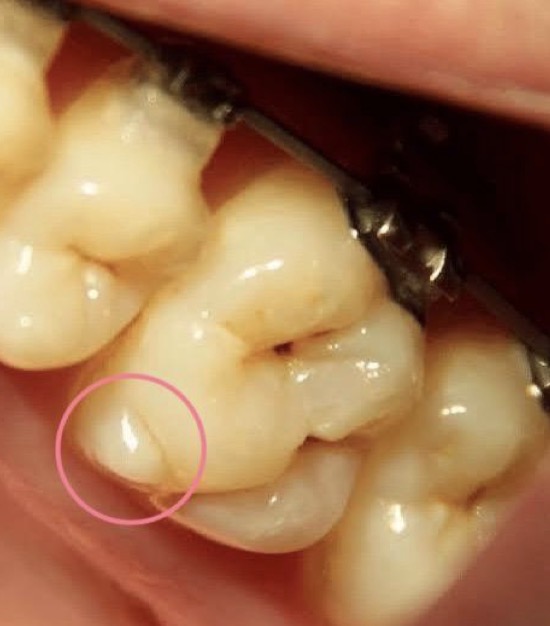 <p>Smaller elevation of some portion of the crown.</p>